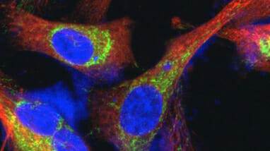 A picture of fluorescent-labeled breast cancer cells. (Submitted photo)